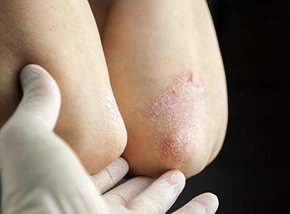 Eczema Algonquin - Barrington IL - Skin Swelling - Atopic Dermatitis