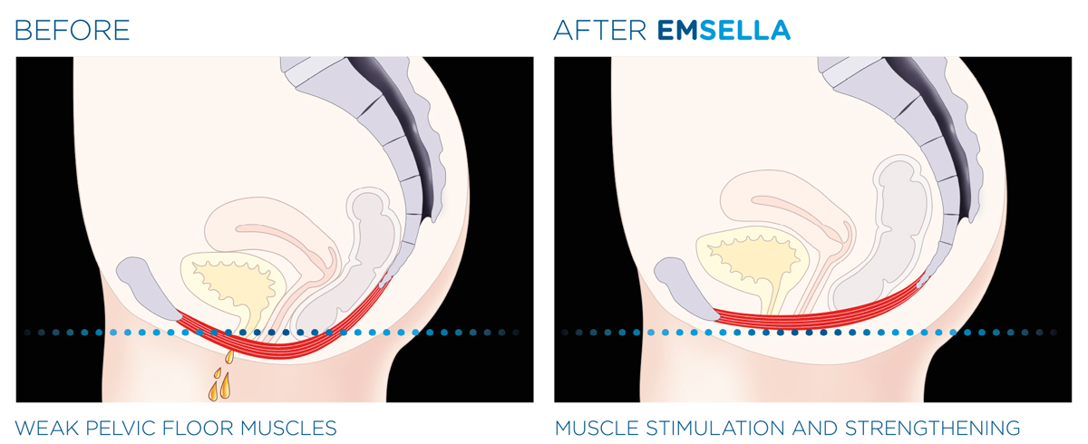Emsella Treatment Before After Results 1
