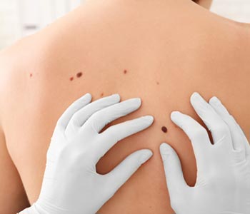 What to expect from mole removal services Near Cary IL area