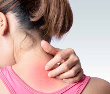Image of a Young Lady suffer from Psoriasis