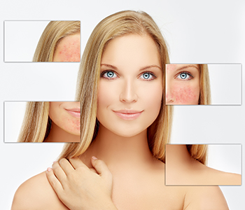 Dr. Khanna Vikram at Dermatology Specialists of Illinois avoids side effects of laser treatment for rosacea, so healthy skin shines through.