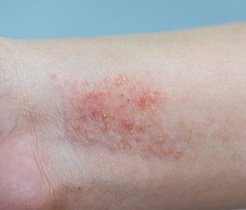 Pictures of common skin rashes, symptoms & treatments