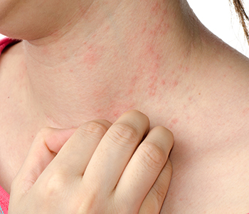 When Is a Rash a Reason to Worry?: Easton Dermatology Associates:  Dermatologists