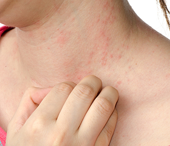 Dr. Khanna Vikram at Dermatology Specialists of Illinois explains about Hives