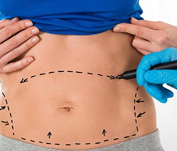 Results from CoolSculpting