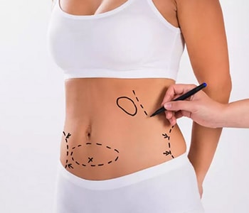 CoolSculpting treatment in Algonquin