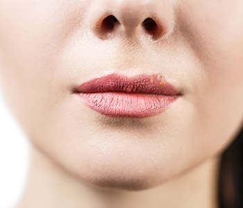 Get Rid of Chapped Lips Algonquin IL area