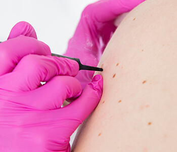 Enjoy the “pros” and avoid the “cons” of mole removal