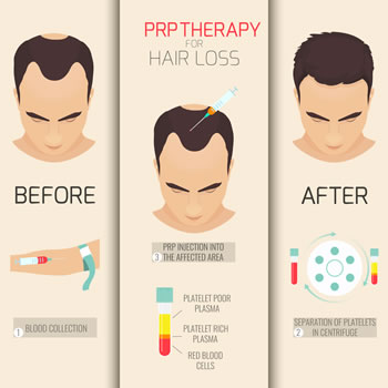 How PRP for Hair Loss Benefits Patients in Algonquin, IL